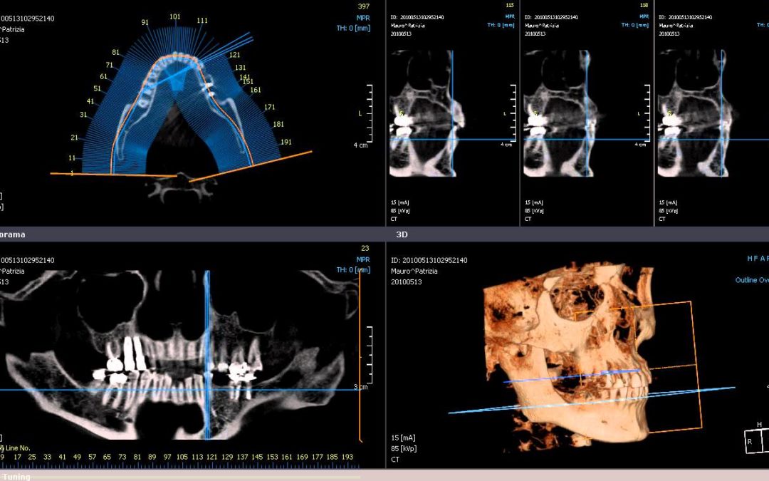 Sai cosè la TAC 3D Cone Beam dentale? (CBCT) - Dott. Maini