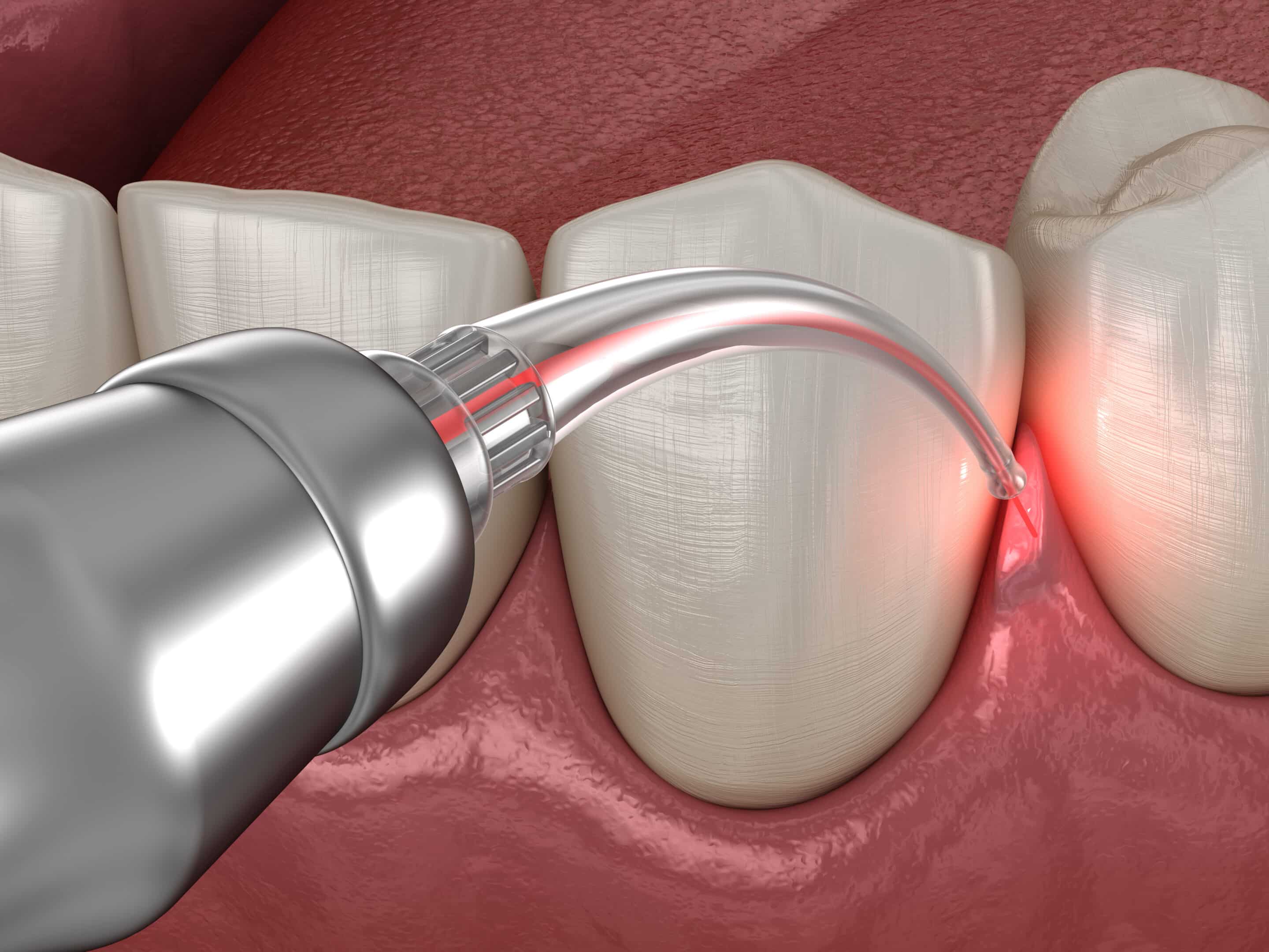 Intervento di correzione gengivale con laser. Dettaglio del laser che cura la gengiva infiammata