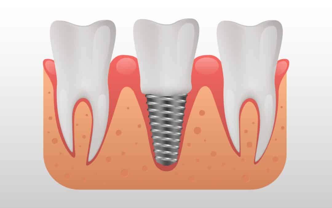 Implantologia Dentale: La soluzione moderna per un sorriso perfetto